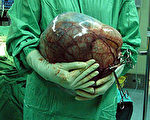 婦女以為增胖  手術取出卵巢瘤重4.5公斤