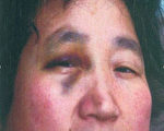 移民婦女韓世巧被公安人員毆打致傷的慘狀（知情者提供）