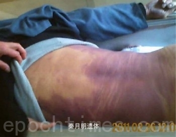 秦月明被迫害致死後遺體留下的傷痕(知情者提供) 秦月明被迫害致死後遺體留下的傷痕(知情者提供)