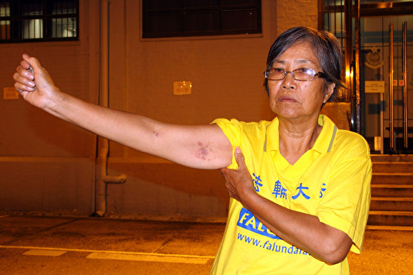 林妹珠遭警员强拉上车,手臂留下瘀痕。(摄影:潘在殊/大纪元) 林妹珠遭警员强拉上车,手臂留下瘀痕。(摄影:潘在殊/大纪元)
