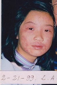 图1:女儿照片摄于一九九九年二月,长达四年的皮肤炎还相当严重。(图:明慧网) 图1:女儿照片摄于一九九九年二月,长达四年的皮肤炎还相当严重。(图:明慧网)