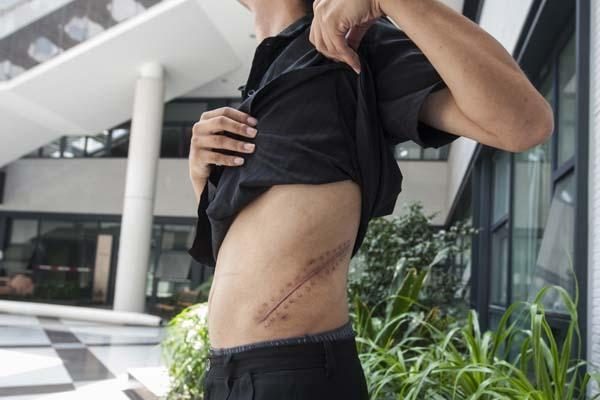 揭露武汉市郊的一栋别墅变成了湖北地下卖肾黑车间的神秘爆料人李伟身上手术刀口触目惊心。(网络图片) 揭露武汉市郊的一栋别墅变成了湖北地下卖肾黑车间的神秘爆料人李伟身上手术刀口触目惊心。(网络图片)