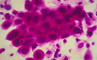 免疫細胞實驗療法 子宮頸癌患者少50%腫瘤