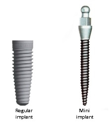 迷你植牙植入體（右）比正常植入體的直徑更細小，一般小於3mm。（雷景祥提供）
