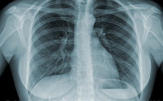 氣流受限是慢阻肺確診特徵