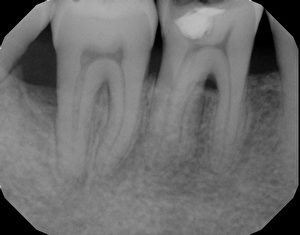 激光治療過後6個月的牙槽骨已經生長。（陶園牙醫提供）