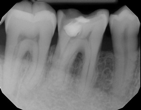 激光治療過後9個月，在沒有植骨情況下，病人的牙槽骨已經長到正常位置了。（陶園牙醫提供）
