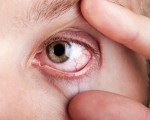 眼睛出現紅血絲 中醫怎麼治？