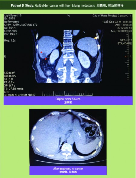 胆囊癌转移,治疗前5-6cm,治疗后癌消失。(廖学时医学博士提供)