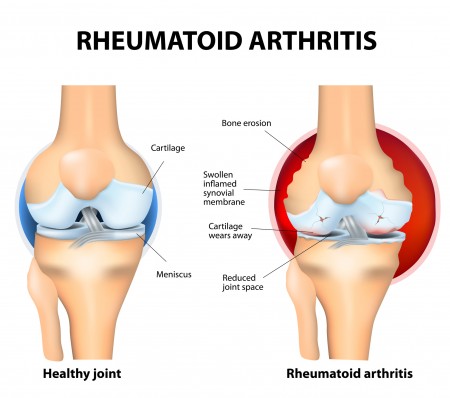 风湿性关节炎（RA）是一种炎症类型的关节炎。通常影响膝盖。膝关节类风湿性关节炎自身免疫疾病。人体的免疫系统错误地攻击健康组织。（Fotolia）