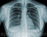 肺癌早期可治愈    哪些影像检查能诊断
