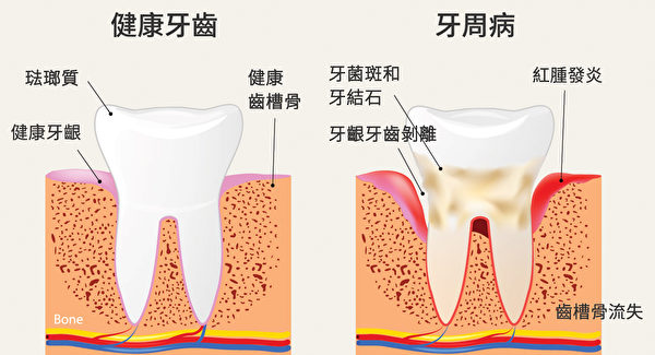 健康牙齿和牙周病牙齿的区别。（Shutterstock/大纪元制图）