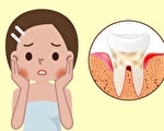 牙龈红肿发炎流血，可能是牙周病症状，牙周病如何治疗？(Shutterstock)