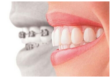 新型牙齒矯正技術比起傳統大鋼牙不只隱形美觀，更方便清潔與進食。（嘉基提供）