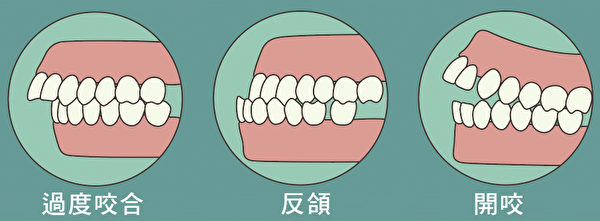 牙齿过度咬合、反颌、开咬，在矫正后，脸型通常会有较好的变化。(nedofedo／Shutterstock)