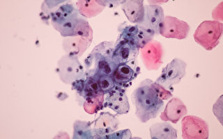 最常見性傳播病毒HPV 如何會引發癌症？