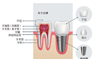 關於種植牙的壽命 6大關鍵因素