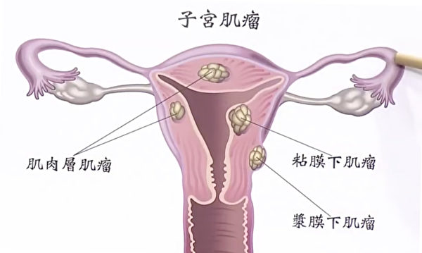 子宫肌瘤的位置不同，对身体的影响也不同。（谈古论今话中医提供）