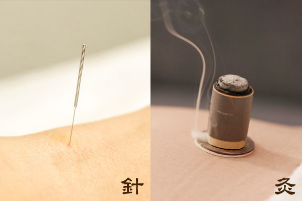 中医治疗方法针灸，分为“针”和“艾灸”两部分。