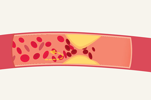 高血脂在什麼情況下應該治療？如何天然降血脂？(Shutterstock)