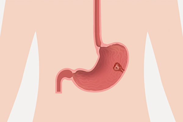 身体检查发现胃息肉怎么办？应该切除吗？(Shutterstock)