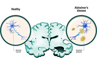 新方法可準確診斷阿茲海默症