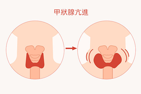 甲狀腺亢進與否，與人體狀況有絕對的關係。（Shutterstock/大紀元製圖）