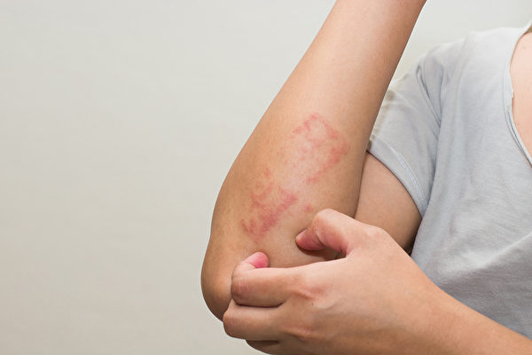 为什么湿疹治不好？中医如何治疗湿疹？(Shutterstock)