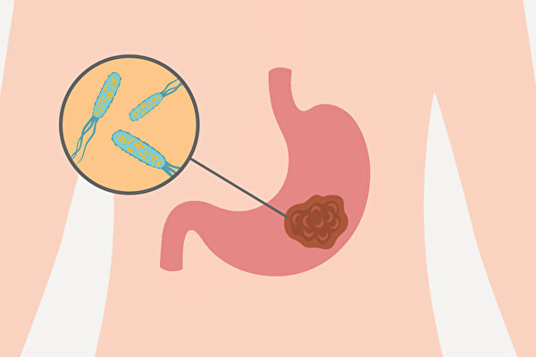幽門螺旋桿菌是胃癌主要風險因子，避免感染或及時殺菌對預防胃癌有很大幫助。（Shutterstock/大紀元製圖）