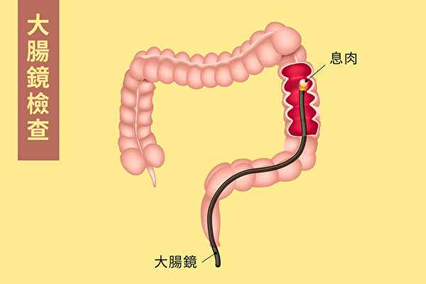 大肠镜检查是通过一条细小柔软的管子伸入直肠里，在管子的头部有微型摄像头，拍摄肠道内的图像，然后显示在屏幕上。（Shutterstock/大纪元制图）