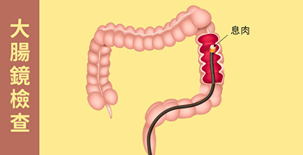 什麼是大腸鏡檢查？做大腸鏡能預防大腸癌嗎？（Shutterstock/大紀元製圖）