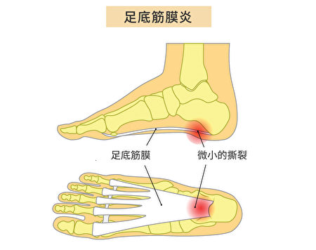 足底筋膜炎（Plantar Fasciitis）是足底筋膜发生炎症，症状是脚后跟疼痛。（Shutterstock/大纪元制图）