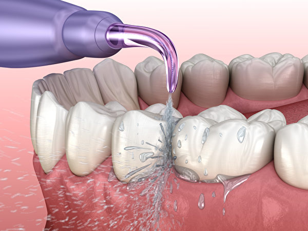 沖牙機不僅可去除牙縫間的殘渣與牙菌斑，還可按摩牙齦。(Shutterstock)