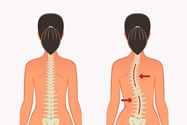 姿势不正确容易造成脊椎侧弯，如何调整？(Shutterstock)