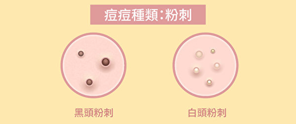 粉刺是没发炎的青春痘，可分为白头粉刺与黑头粉刺。（Shutterstock/大纪元制图）