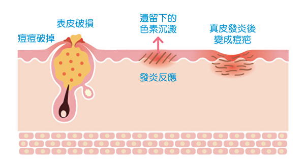 並非不擠痘痘就不會留下疤痕，只要出現發炎免疫反應，就有可能留下痘疤。（商周出版提供）