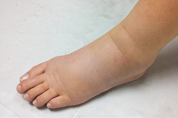 生理性水肿多半只是双脚对称性水肿，且恢复得很快。病理性水肿可能是单脚水肿，或双脚水肿伴随其它部位水肿。(Shutterstock)