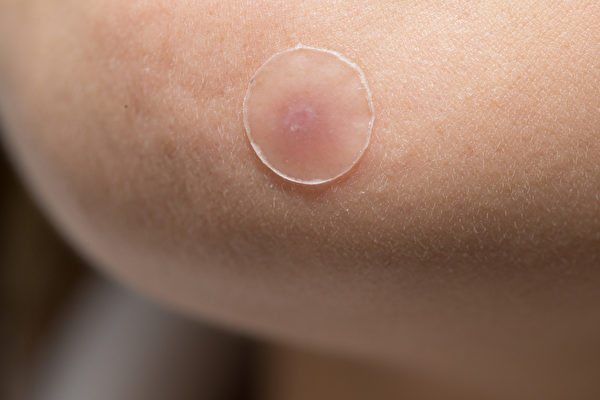对于脓包已被挤破的脓疱型青春痘，使用痘痘贴能吸收化脓，并避免伤口感染。(Shutterstock)