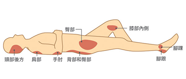 最常长褥疮的身体部位包括臀部、肩部、背部、脑部后方等。（Shutterstock/大纪元制图）