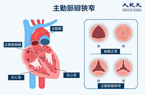 若主動脈瓣膜狹窄，不能完全打開，就會導致從心臟到身體各處的血流減少。（Shutterstock/大紀元製圖）