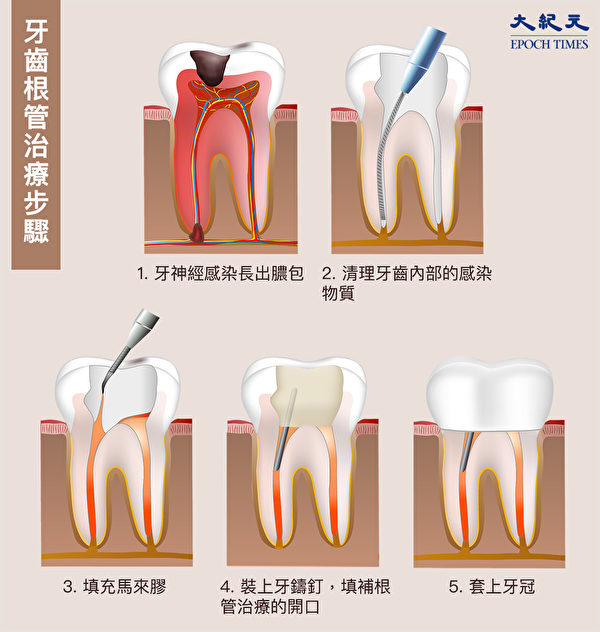 蛀牙根管治療（抽神經）的步驟。（Shutterstock/大紀元製圖）