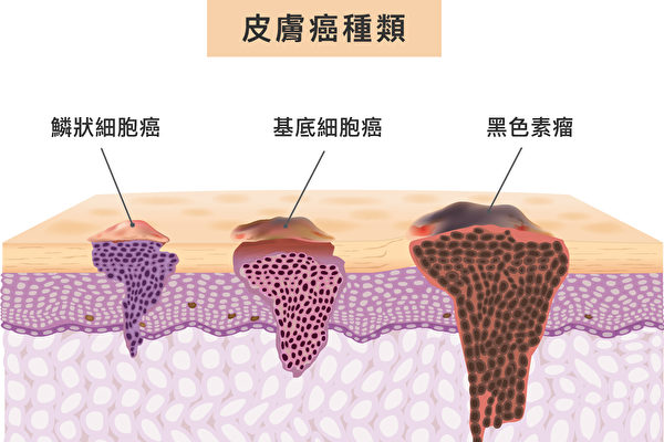 常見的皮膚癌有三種：基底細胞癌、鱗狀細胞癌、惡性黑色素瘤，表現在皮膚上各有不同的症狀。（Shutterstock/大紀元製圖）