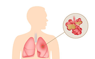 不只是咳嗽和发烧 肺炎的突出症状有哪些？