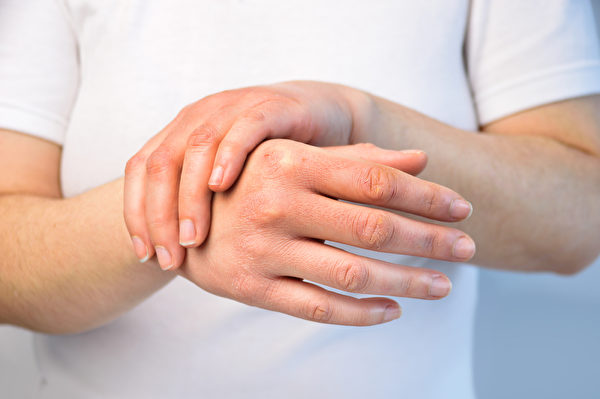 類風濕性關節炎是常見自體免疫疾病。(Shutterstock)