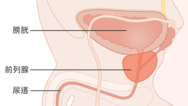 前列腺癌肿瘤细胞则更倾向于发生在前列腺的边缘。(Wikimedia Commons)