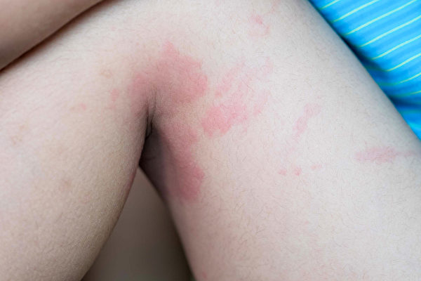 部分中共肺炎患者出現皮膚症狀，如蕁麻疹等皮膚疹、斑塊或水泡。示意圖。(Shutterstock)