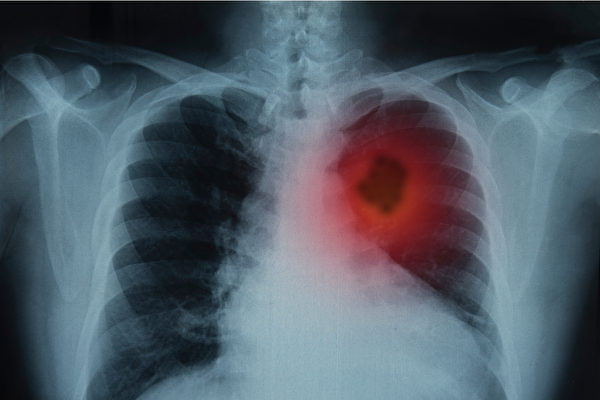 近年来，空污与肺癌的关联越来越凸显。(Shutterstock)