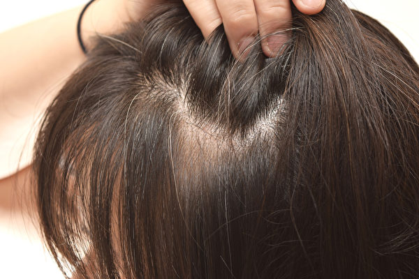 引起头皮屑的原因有哪些，如何挑选抗屑洗发精？(Shutterstock)