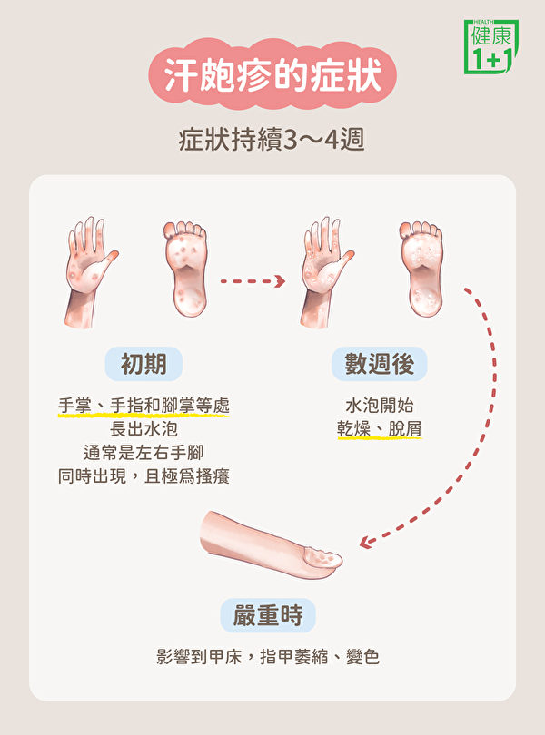 汗疱疹的症状主要表现为水泡和骚痒,大部分水泡都出现在手掌、手指以及脚掌。(健康1+1/大纪元)