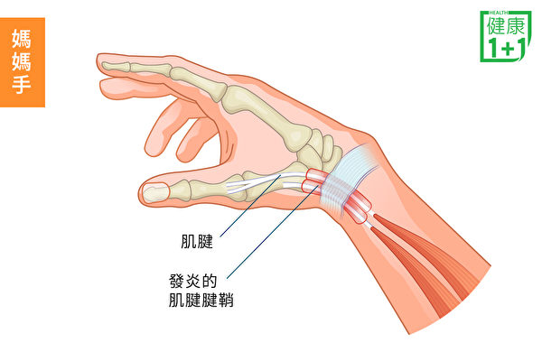 過度使用手，可能會刺激拇指到手腕一側的肌腱，引起媽媽手症狀。（健康1+1／大紀元）